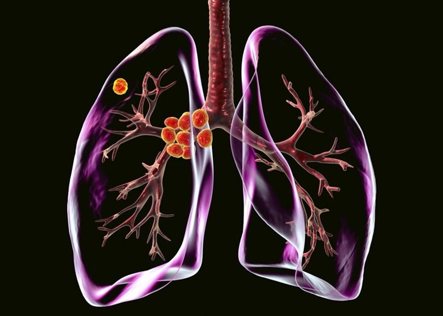 Yeni bir keşif pulmoner fibrozun (FR) tedavisinin önünü açıyor. Yeni bir keşif pulmoner fibrozun tedavisinin yolunu açıyor.