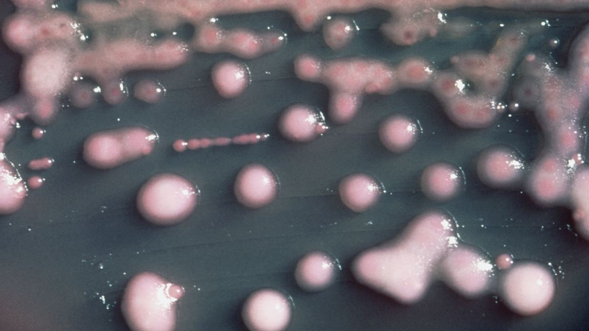 The imaging indicated inflammation in her right eye, but also picked up lesions in her brain. She had abruptly lost vision in her right eye.
