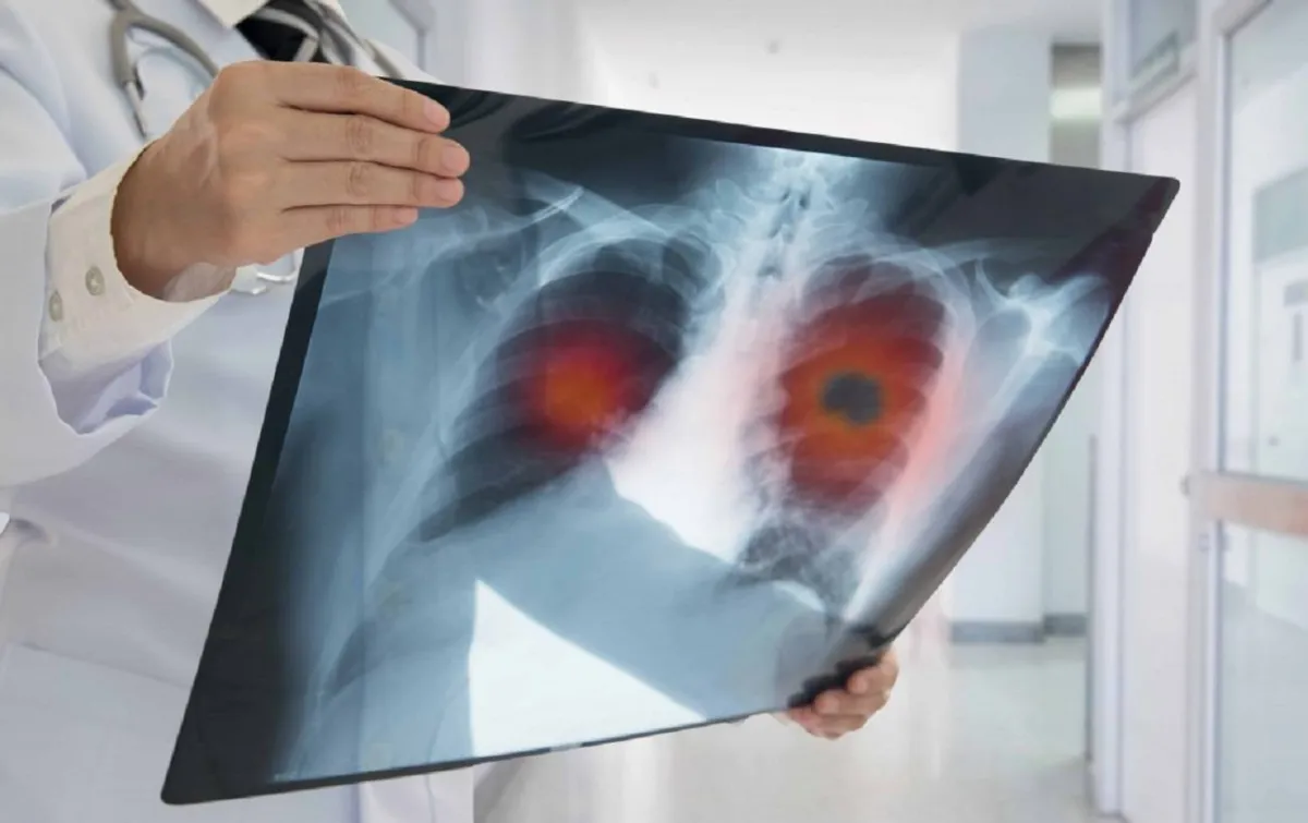 Die Ergebnisse einer neuen Studie stellen langjährige Leitlinien in Frage, wonach Patienten mit Lungenkrebs im Stadium IV zumindest für eine