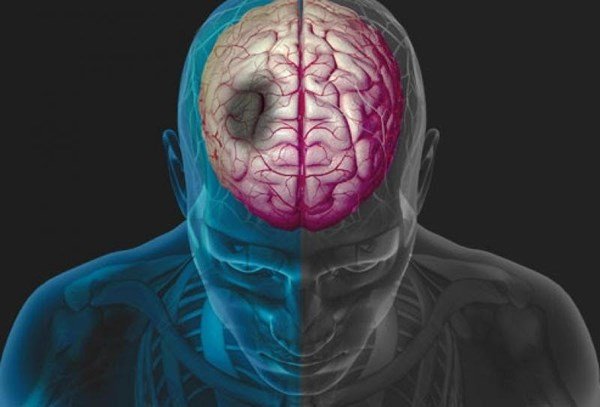 Information/Continue... Dr. Natalia Kadymova, a neurologist, warned that headaches accompanied by facial changes, weakness in the extremitie